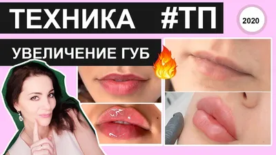 Техники увеличения губ: «Парижские (французские) губы» | filler.by