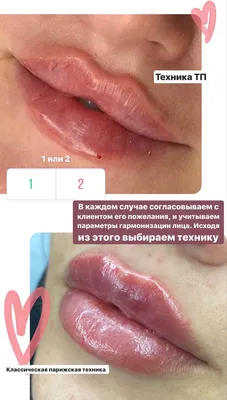 Kosmetolog Vita Sviatobog - 💋Красивые губы - мечта каждой девушки!💋 ⠀  ❤️Сейчас техники увеличения губ очень усовершенствовались и современный  косметолог владеет лучшими техниками. ⠀ ❤️Техника ТП - расшифровка - техника  поверхностная. Что