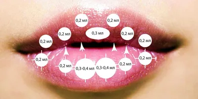 Процедура по увеличения губ техники и результаты. Фото - Косметология  доктора Корчагиной