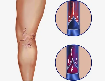 Обзор лекарственных средств при варикозном расширении вен