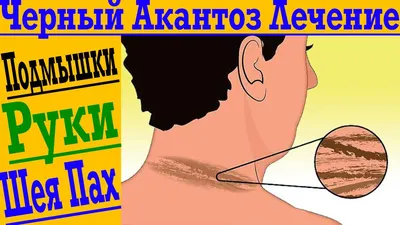 Чёрный Акантоз! Тёмная кожа в паху, подмышках, шее на затылке! - YouTube