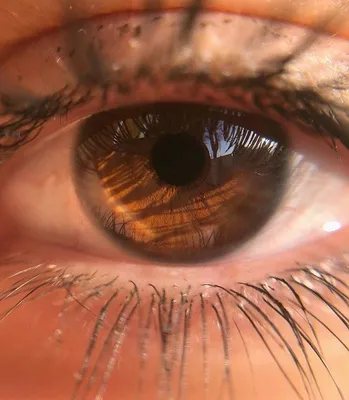Цвет глаз влияет на предрасположенность к болезням – исследование