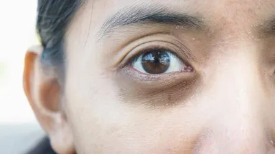 На какие заболевания указывают тёмные круги под глазами - врач