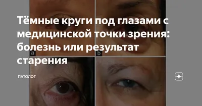 Тёмные круги под глазами с медицинской точки зрения: болезнь или результат  старения | Патолог | Дзен