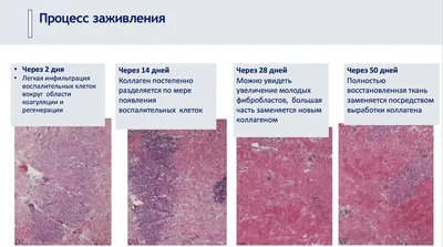 Результат сразу после процедуры SMAS-лифтинга Альтера-терапии