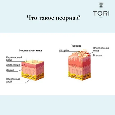 Врач поставил диагноз «псориаз». Что теперь делать? | Новости Таджикистана  ASIA-Plus