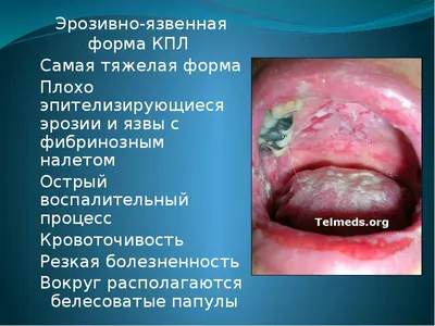 Псориаз: причины, виды, симптомы и лечение