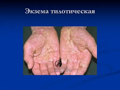 Экзема на руках: лечение, мази, препараты, народные средства - Симптомы и  диагностика болезни