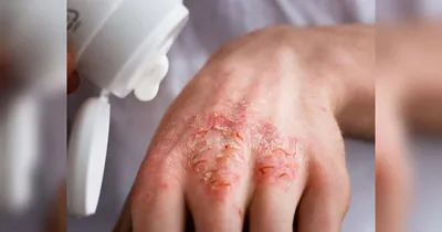 Средство для защиты восстановления кожи ЗАО \"Оберон\" Эплан - «Быстро  восстанавливает кожу при дисгидротической экземе . Фото до и после» | отзывы
