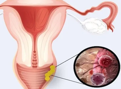 Обзор раковых опухолей органов женской репродуктивной системы - Проблемы со  здоровьем у женщин - Справочник MSD Версия для потребителей