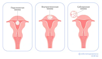 Классификация женских половых органов: что такое «сиповка» и «королёк»?