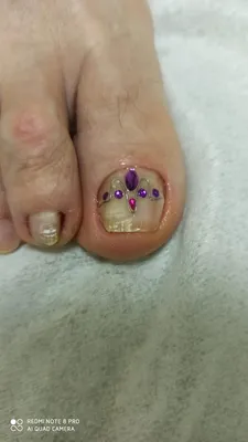 PEDICURE 🌸 Dynamics of nail alignment using titanium wire (NiTi) 🌸 Сlean  subungual calluses - YouTube