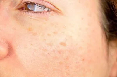 Как выглядит рак кожи — признаки и симптомы меланомы, базалиомы