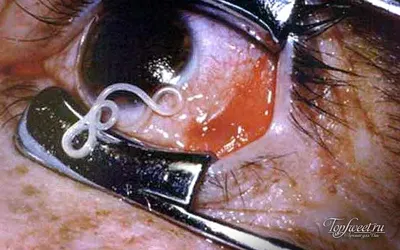 ТОП 10 страшных заболеваний глаз, вызванных паразитами