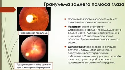 токсокароз презентация, доклад, проект