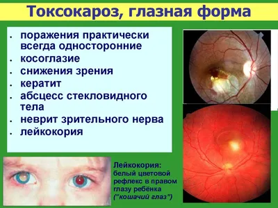 Дальнозоркость - причины появления, симптомы заболевания, диагностика и  способы лечения