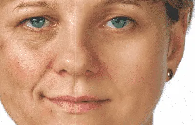 Как уплотнить кожу лица - проблемы и решения в клинике Cleo Line