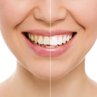 улыбающаяся молодая женщина. косметологическое побеливание зубов в  стоматологической клинике. выбор тона имплантатного зуба Стоковое Фото -  изображение насчитывающей взорвать, профессионал: 234163714