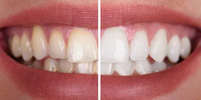 Реставрация 6-ти передних верхних зубов винирами и коронками