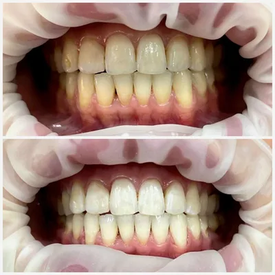 Отбеливание зубов | Дента-Кристалл