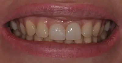 Отбеливание зубов | Акция 2024 | Стоматология Dental Park