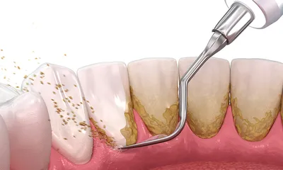 Клинический случай отбеливания зубов zoom-4 | Стоматология СТУДИЯ УЛЫБОК г.  Сочи | Дзен