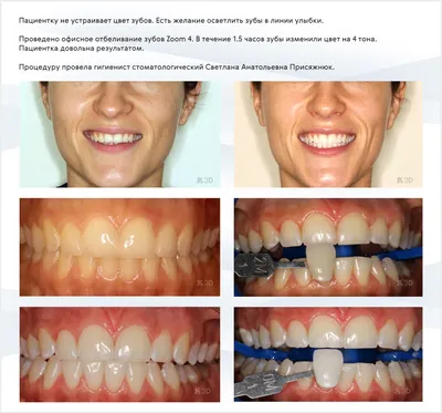 Пигментация зубов [как удалить дисколорит эмали, лечение и чистка]