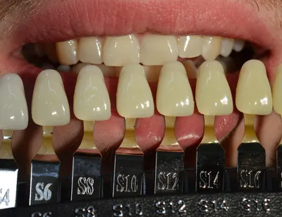 Отбеливание зубов 🦷 в МедСистема. Цена, стоимость