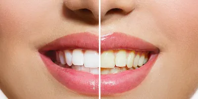 Выбираем цвет виниров | Журнал Startsmile о стоматологии | Дзен