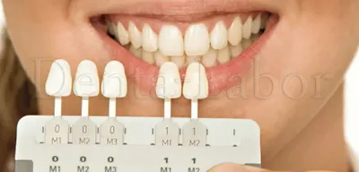 Шкала Вита - назначение, применение в стоматологии