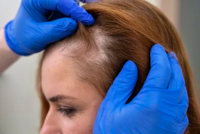 Очаговая алопеция – процесс прогрессирующего выпадения волос на голове или  других волосистых участках кожи. Очаговую алопецию… | Instagram