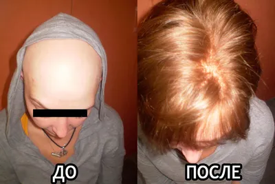 Лечение алопеции в Москве — Причины выпадения волос у мужчин и женщин — Как  остановить выпадение и поредение волос