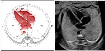 Small abnormalities of the heart and an open oval window: myths and reality  - Rybakova - Consilium Medicum