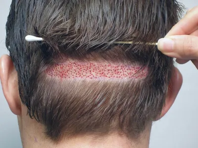 Трансплантация бровей : CatchLife Hair | Hair Transplantation Antalya,  Turkey