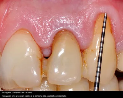 Травма зуба, фото лечения Центра Имплантологии