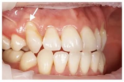 Рецессия Десны Опустилась Что Это Такое Причины ЛюмиДент