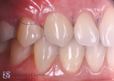 Здоровая десна: красота вокруг зубов | Colibri Dental