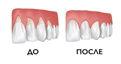 Воспаление зубов (десен) - лечение в стоматологии \"Дента\"