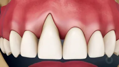 Перикоронит, затрудненное прорезывание зубов (мудрости) — причины, симптомы  и лечение. — CLINICIN.RU