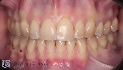 Травма зуба: что это, и как необходимо действовать? | Журнал Startsmile о  стоматологии | Дзен
