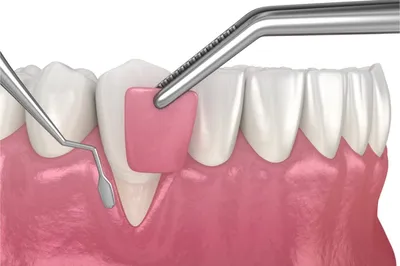 Почему разрушаются зубы? Травматическая окклюзия и травматические узлы, как  быть с зубными имплантами