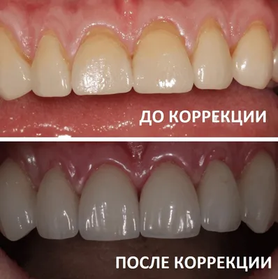 dr.boris.nalitkin До/после - травма зуба, продольный перелом зуба 11.  Имплантация в области 11 зуба, пластика десны, коронка из диоксида… |  Instagram