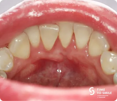 Опухла десна после лечения зуба - Что делать и куда обращаться?
