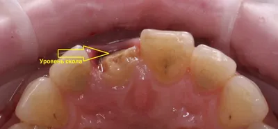 Травма зуба, перелом коронковой части переднего зуба. Реставрация  фотополимером