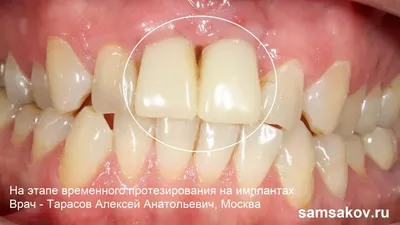 Виды и лечение травм зубов — острые и хронические, механические и химические