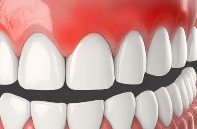 Почему разрушаются зубы? Травматическая окклюзия и травматические узлы, как  быть с зубными имплантами