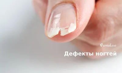 Борозды Бо-Рейля – что означают вмятины на ногтях, симптомы, причины  появления, лечение и профилактика