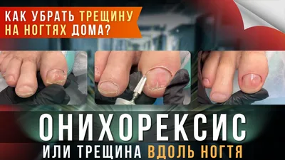 Продольные трещины на ногтях - Вопрос подологу - 03 Онлайн