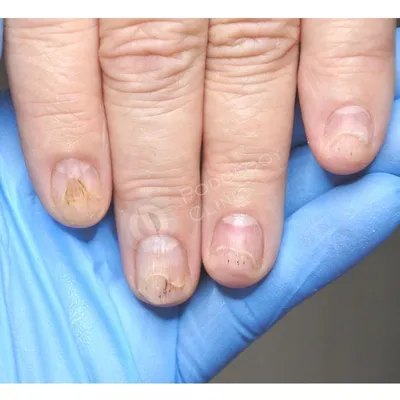 Болезни ногтей: виды, симптомы, лечения и профилактика - FitoBlog