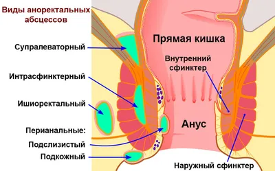 Парапроктит - причины, симптомы, диагностика и лечение